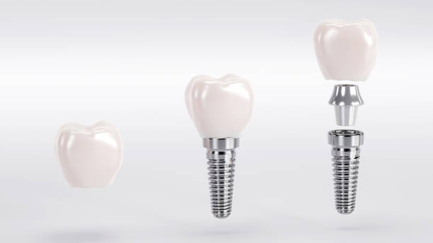 Dental Begastri - Implantes Dentales